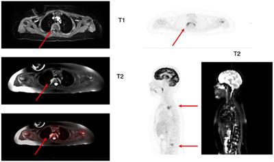 Case report: sub-clinical extramedullary B-ALL in the setting of relapse following targeted therapy